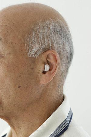 きれいに短期間で行う成人の矯正